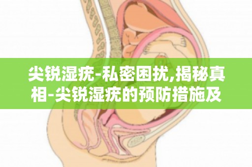 尖锐湿疣-私密困扰,揭秘真相-尖锐湿疣的预防措施及日常生活注意事项